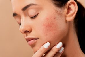 Lee más sobre el artículo ¿Cómo afecta el estrés a la piel? Consejos para combatirlo