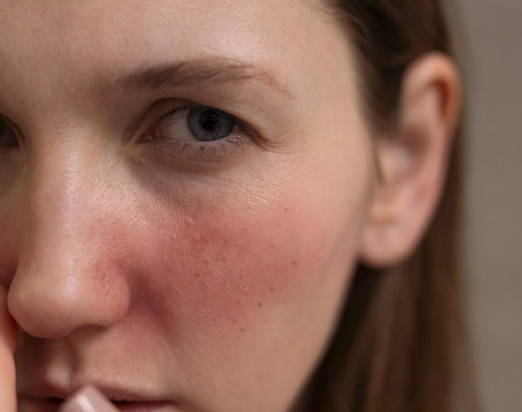 Woman Dealing With Rosacea Skin Condition Face Scaled E1713202665415 1024x807