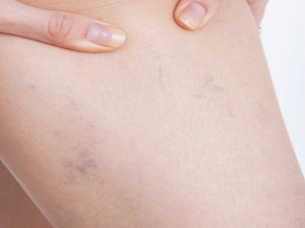 Varices (2)
